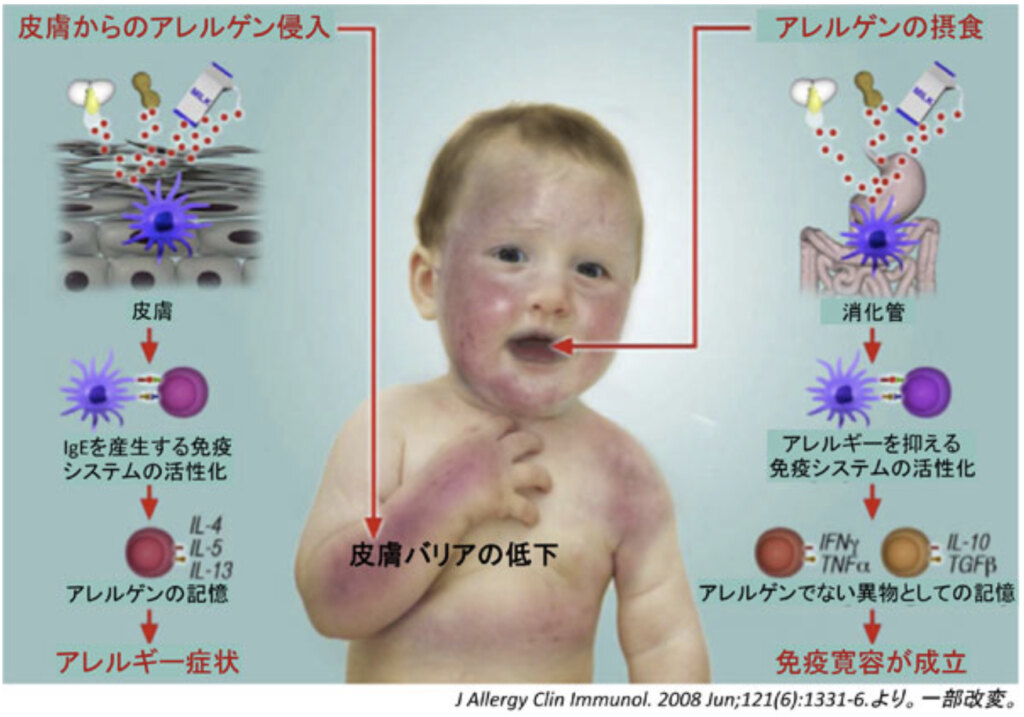 食物アレルギー②予防にはスキンケア?経皮感作と皮膚バリア - 寒川こどもとアレルギーのブログ