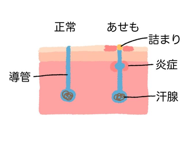 あせもの模式図