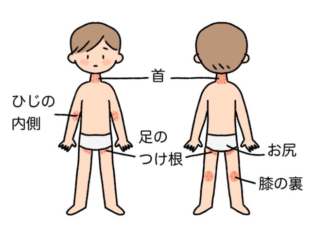 湿疹の好発部位